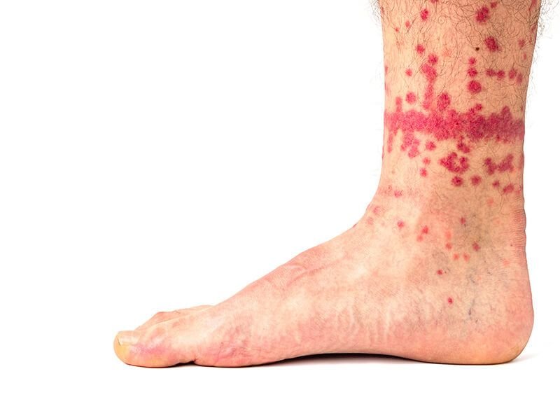 Flea and tick allergy skin rash