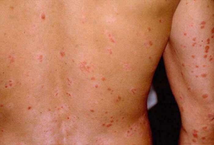 Flea and tick treatment Melton