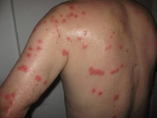 Bed Bug Control in Melbourne